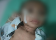 Open Donasi Ditutup, Ini Total Dana Terkumpul Untuk Pengobatan Kayla